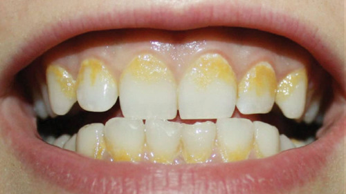 Biofilm Blog Dental Cleaning Maintenance Kennewick WA Clearwater Dental