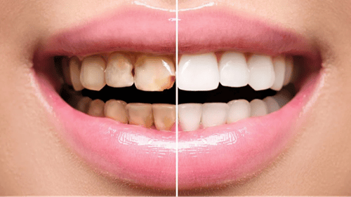 Veneers Kennewick Washington Clearwater Dental