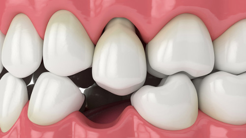 Dental Tooth Implants Kennewick Washington Clearwater Dental